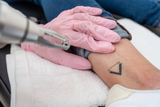 Eliminación de tatuajes